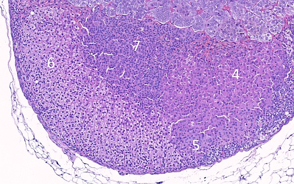 Case #25, Fig. 11