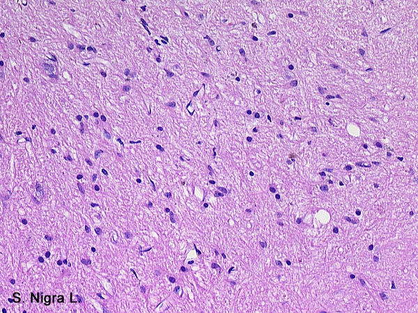 Case # 13, Fig. 1