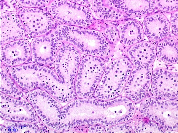 Case # 4, Fig. 1: Biopsy, control before study