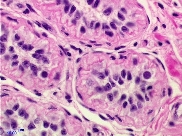 Case # 4, Fig. 4: Treated testis after 13 weeks